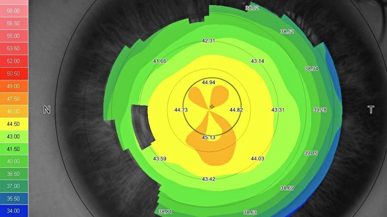 Cornea topográfia alkalmazása és kiértékelése